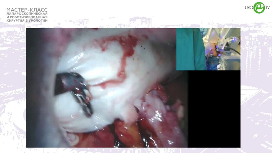 Медведев В.Л. - Робот-ассистированная чрескожная адэномэктомия