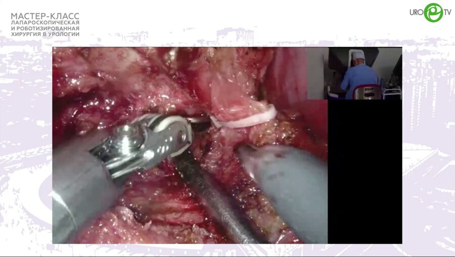 Пушкарь Д.Ю. - Робот-ассистированная радикальная простатэктомия с нервосбережением