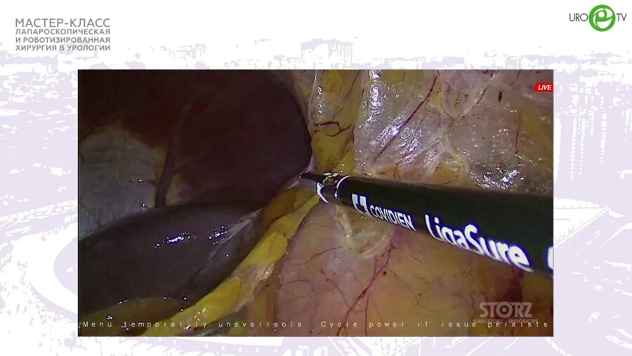 Трусов П.В. - Лапароскопическая резекция почки с образованием. RENAL 7