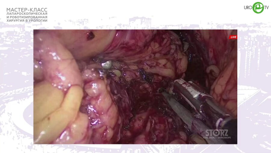 Михайлов И.В. - Лапароскопическая цистпростатвезикулэктомия