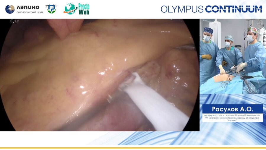 Расулов А.О. - Лапароскопическая правосторонняя гимеколоктомия каудо-краниальным доступом
