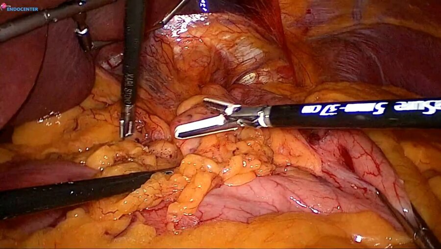Laparoscopic Hiatal hernia