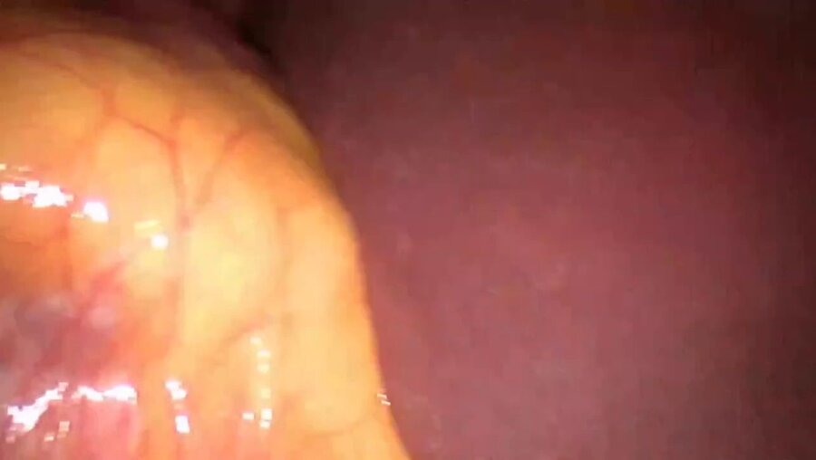 Laparoscopic Huge nephradrenalectomy aortocaval LND LIVE