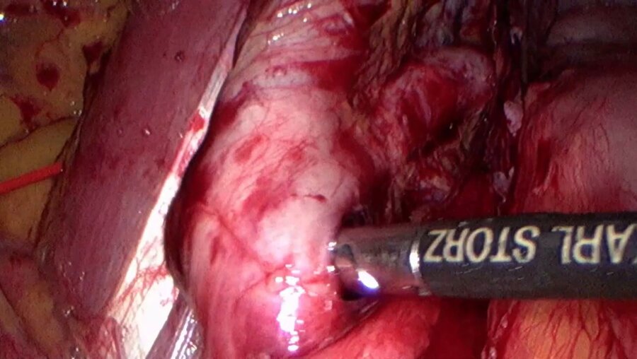 Laparoscopic Huge pelvic tumor