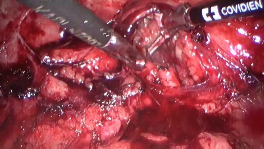 LaparoscopIc intestinal ureteroplasty LIVE