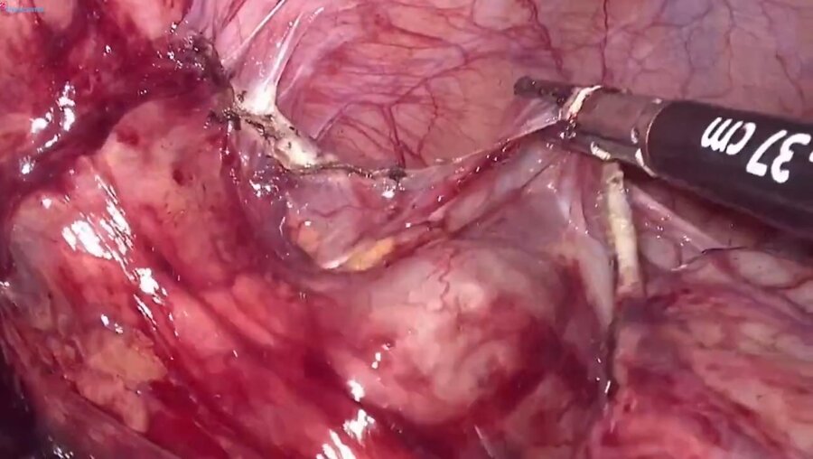 Laparoscopic Intestinal ureteroplasty LIVE
