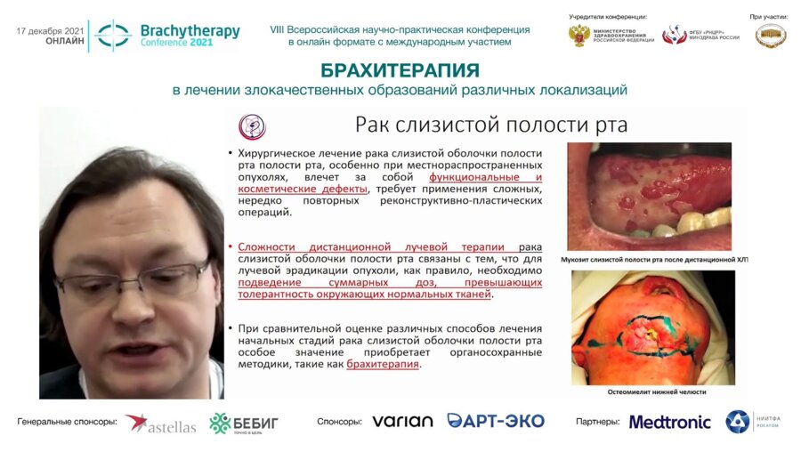 Севрюков Ф.Е. - Место брахитерапии источниками калифорния - 252(CF-252) при лечении рака слизистой оболочки полости рта