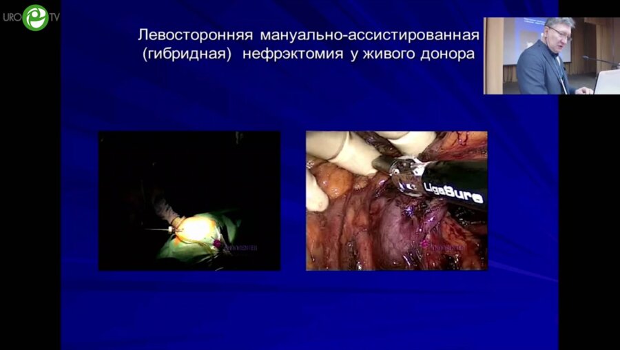 Галлямов Э.А. - Лапароскопическая мануально-ассоциированная донорская нефрэктомия