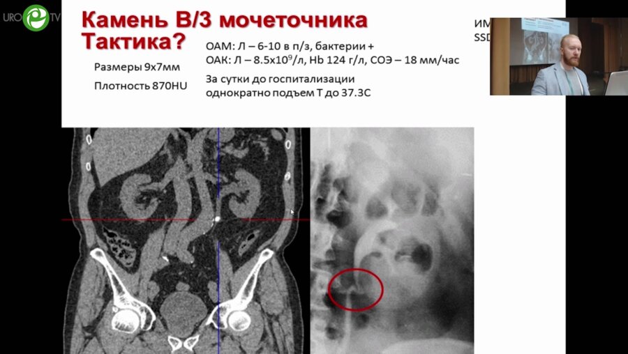 Ершов А.В. - Разработка нейросетевого классификатора при выборе метода лечения МКБ
