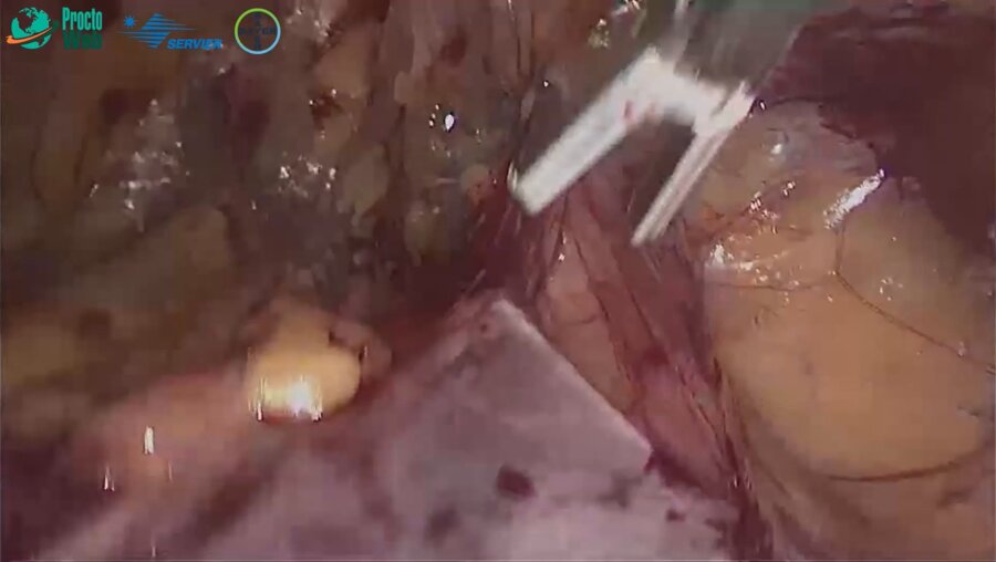 Агапов М.А. - Герниопластика паховой грыжи