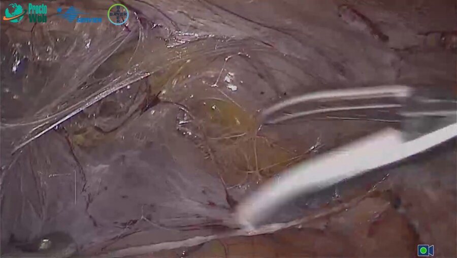 Агапов М.А. - Оперативное лечение выпадения прямой кишки