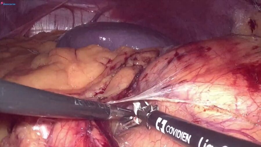 Laparoscopic left partial nephrectomy LIVE