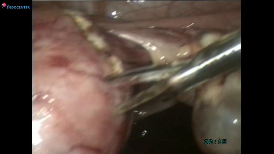 Laparoscopic myomectomy