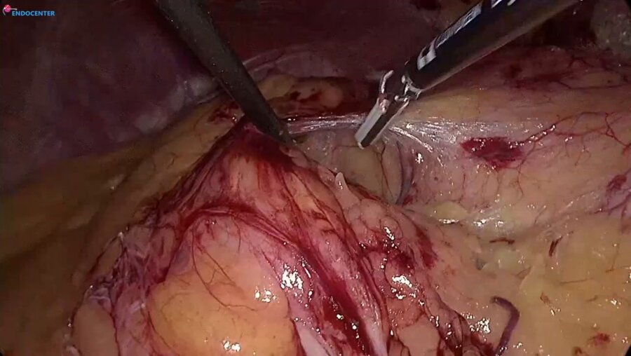 Laparoscopic left partial nephrectomy, zero ischemia