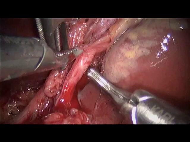 Laparoscopic living donor hepatic resection