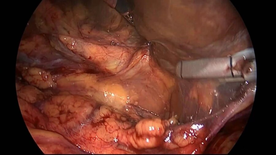 Биктимиров Р. Б. - Лапароскопическая билатеральная нефрэктомия