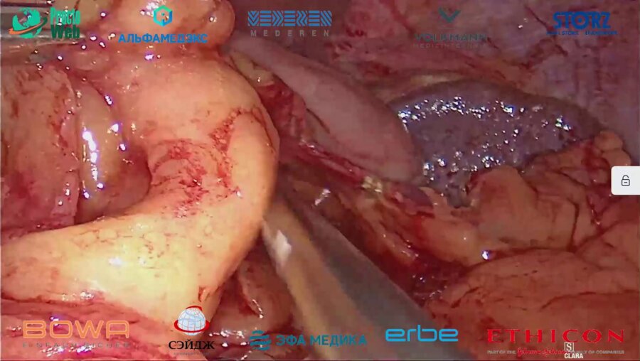 Галлямов Э.А - Лапроскопический ретроцервикальный эндометриоз