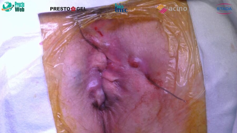 Маркарьян Д.Р. - Оперативное лечение сложного свища прямой кишки