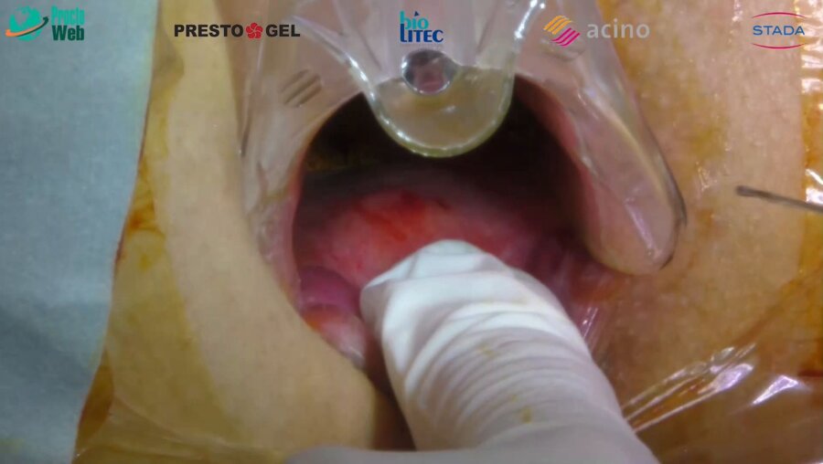 Маркарьян Д.Р. - Оперативное лечение сложного свища прямой кишки