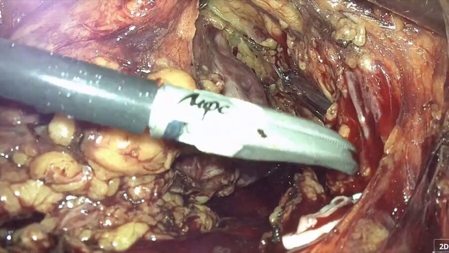 Laparoscopic nephrectomy & anterior exenteration LIVE  Нефрэктомия, передняя эк