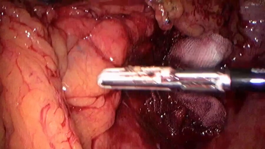 Laparoscopic pelvic abscess, sigmoid resection