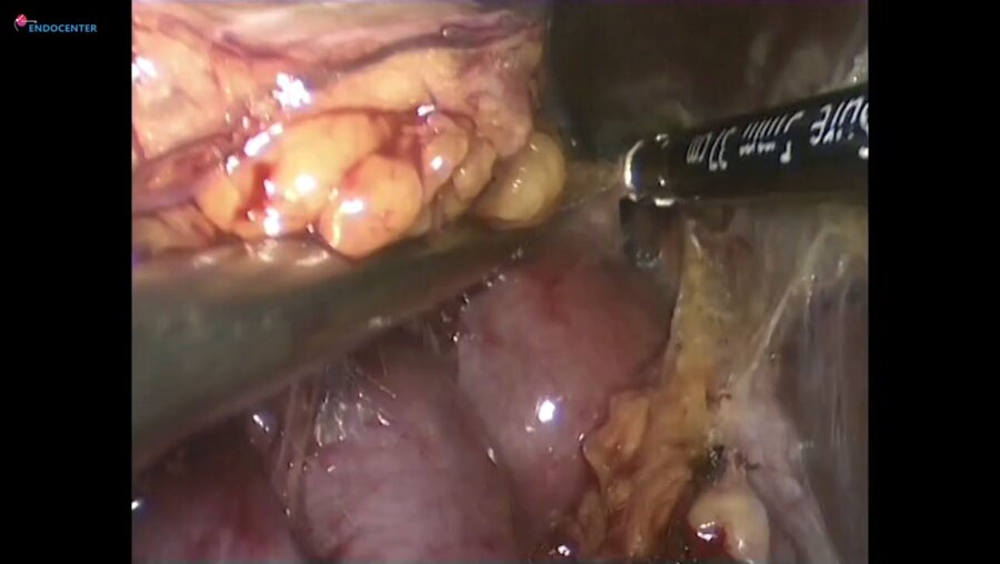 Laparoscopic partial nephrectomy Huge hilar -  Резекция почки в воротах RENAL 12