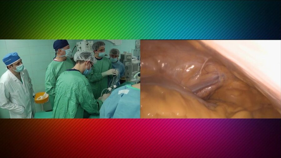 Laparoscopic partial nephrectomy LIVE - Резекция почки