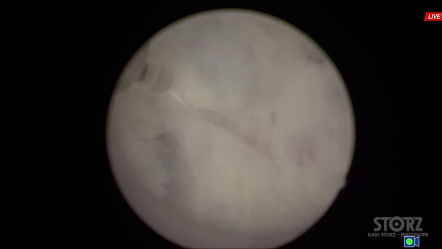 Трансуретральная энуклеация простаты (dornier medilas solvo h35)