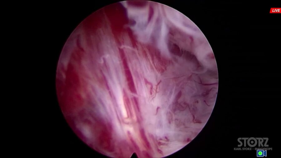 Трансуретральная энуклеация простаты boston scientific auriga xl