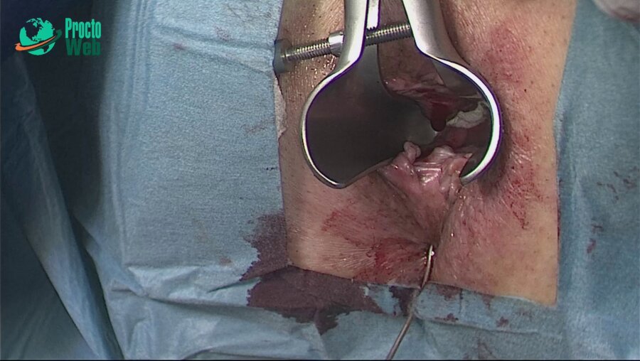 Маркарьян Д.Р. - Оперативное лечение сложного транссфинктерного свища прямой кишки