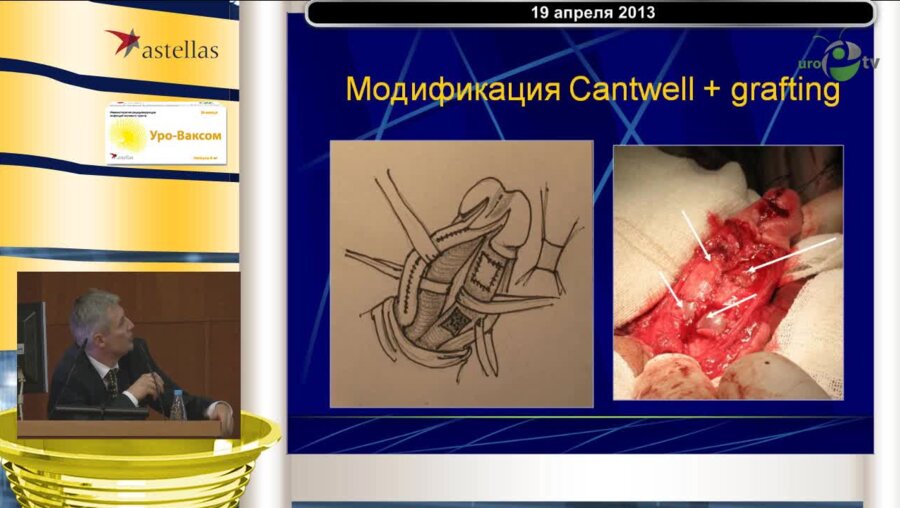 Рудин Ю.Э. "Этапное лечение экстрофии мочевого пузыря у детей"
