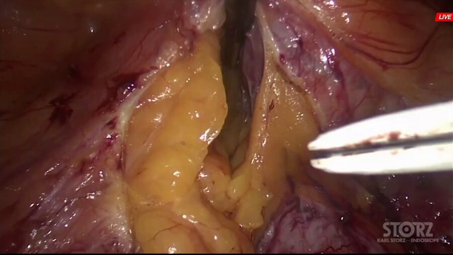 Laparoscopic pyeloplasty _ Лапароскопическая пластика ЛМС