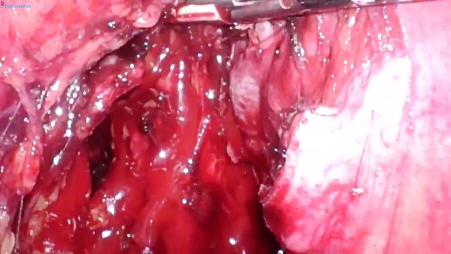 Laparoscopic radical cystectomy Bricker LIVE _ Радикальная цистэктомия деривация