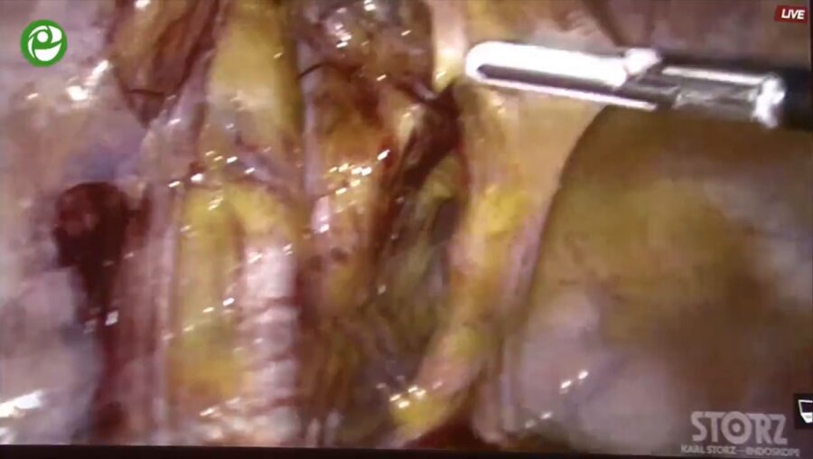Laparoscopic Radical cystprostatectomy with intracorporeal orthotopic ileal neob