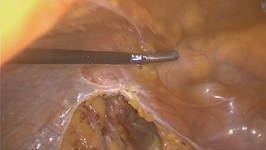 Laparoscopic radical hysterectomy with aorto pelvic LND _Радикальная гистерэктом
