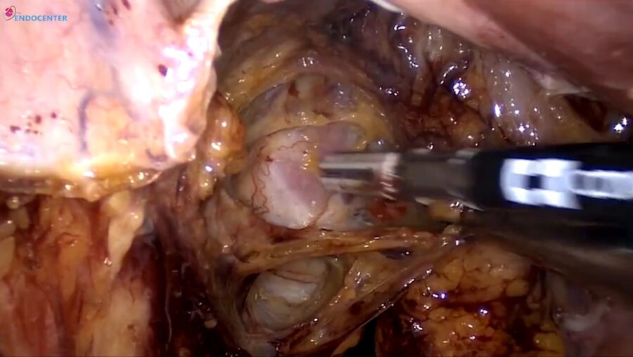 Laparoscopic radical hysterectomy, pelvic LND _ Радикальная гистерэктомия с тазо