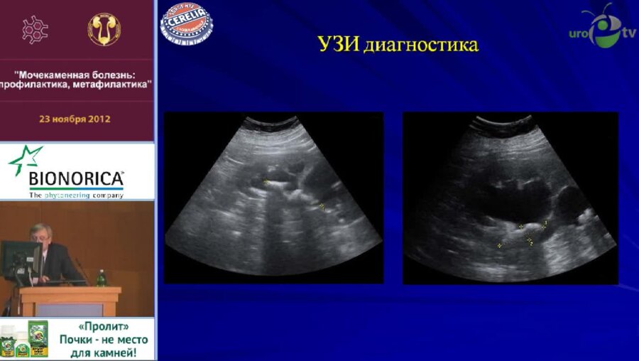 Теодорович О.В. "Особенности диагностики, оперативного лечения и метофилактики при коралловидном нефролитиазе"