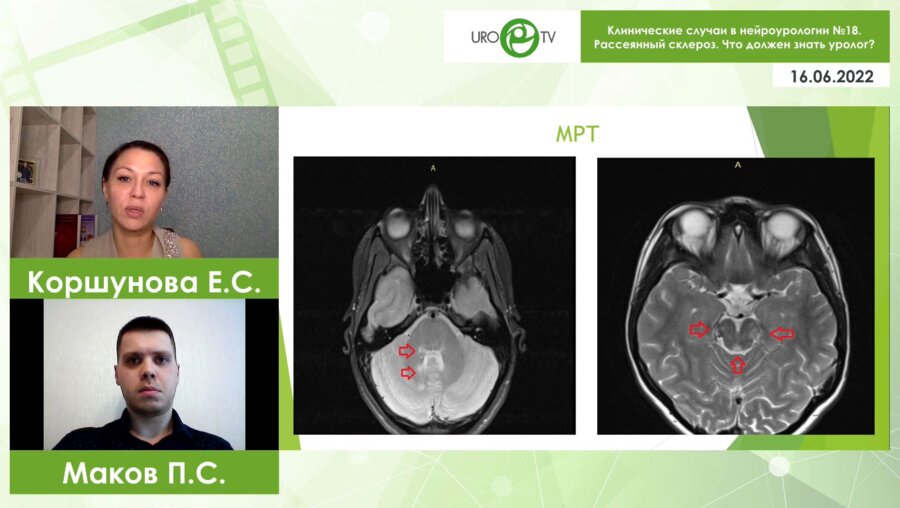 Вебинар. Клинические случаи в нейроурологии №18. Рассеянный склероз. Что должен знать уролог?