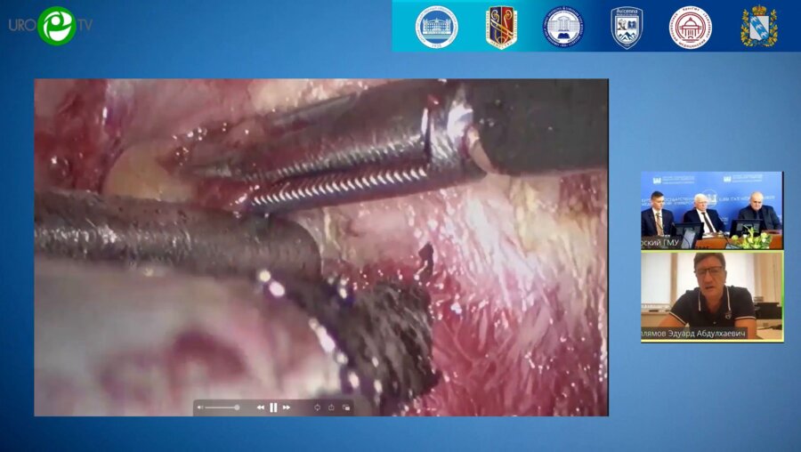 Галлямов Э.А. - Лапароскопическая простатэктомия (видеооперация)