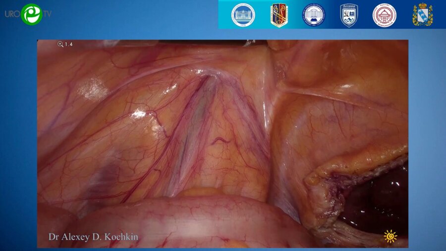 Кочкин А.Д. - Лапароскопическая трансвезикальная аденомэктомия (видеооперация)