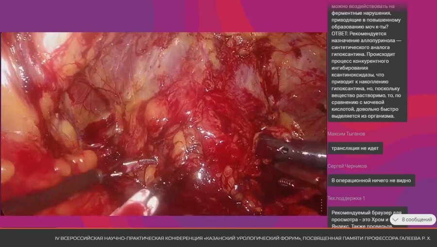 Операция 3. Лапароскопическая нервосберегающая простатэктомия