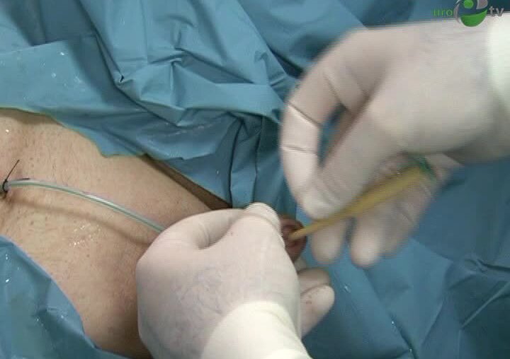 Криоаблация предстательной железы