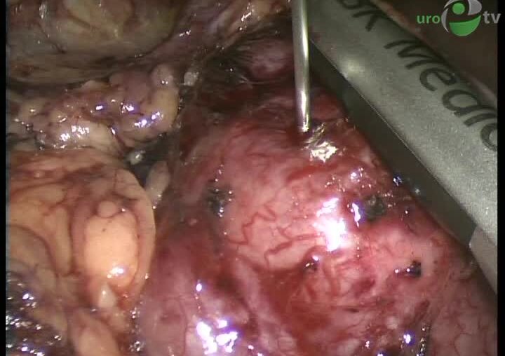 Криоаблация почки