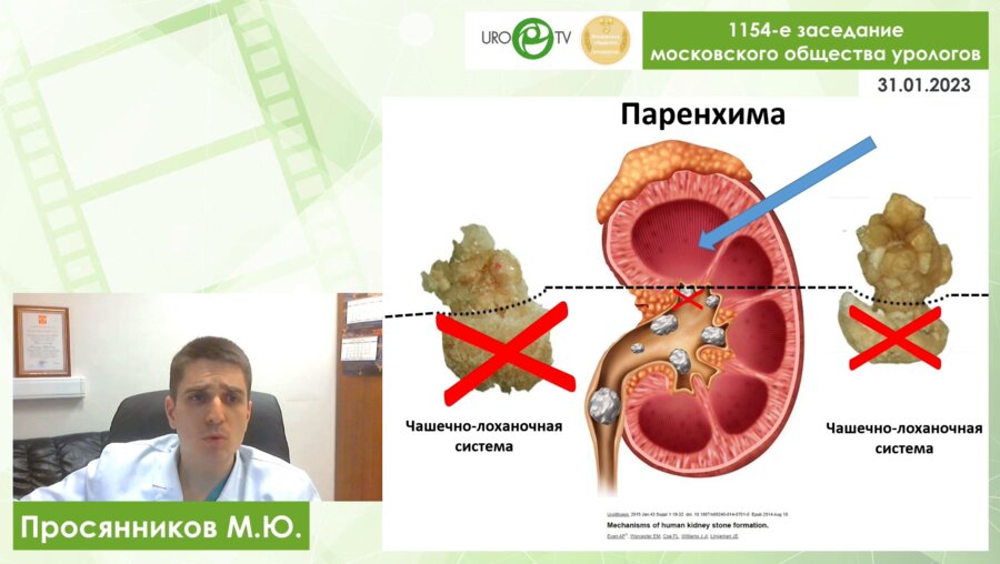 Просянников М.Ю. - Патогенетически обоснованная метафилактика мочекаменной болезни