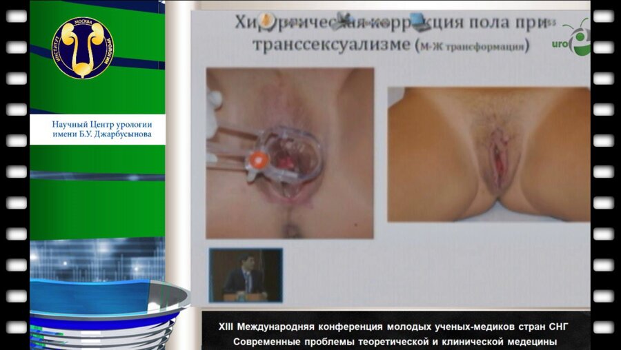 Нугманов Ч.А. "Генитальная хирургия. Новые внедрения в практику"