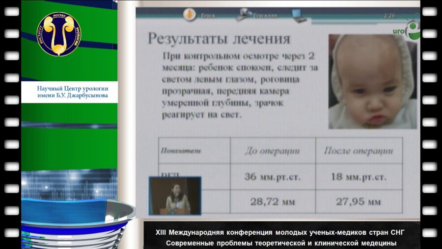 Сангилбаева Ж.О. "Случай врожденной глаукомы у ребенка с нейрофиброматозом Реклингхаузена"