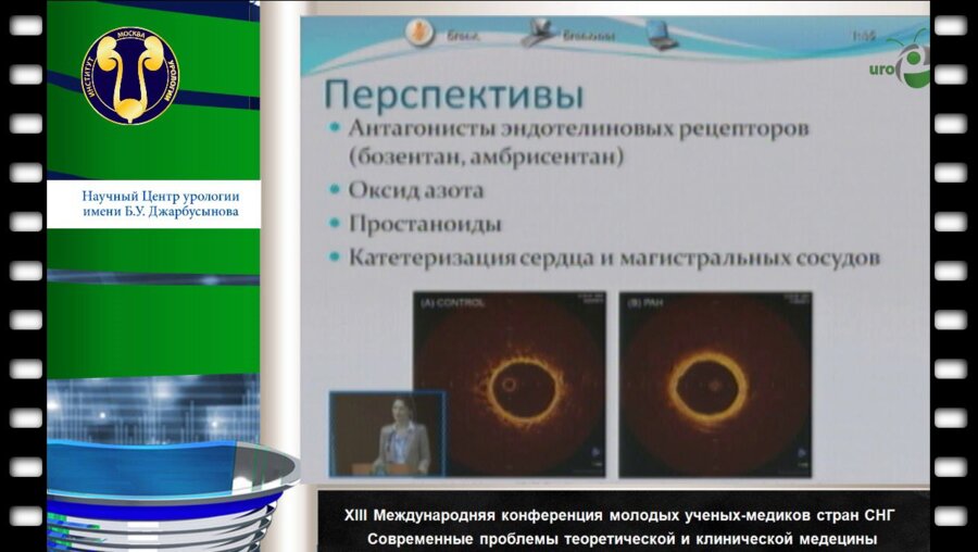 Тойбаева А.К. "Опыт диагностики и лечения легочной гипертензии у детей с врожденными пороками сердца ...."