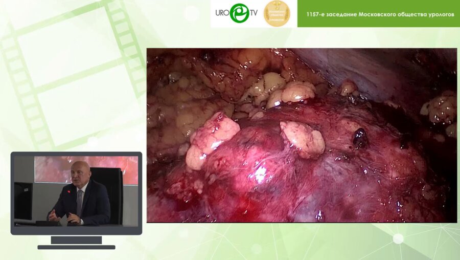 Биктимиров Р.Г. - Резекция почки в условиях сохраненного кровотока