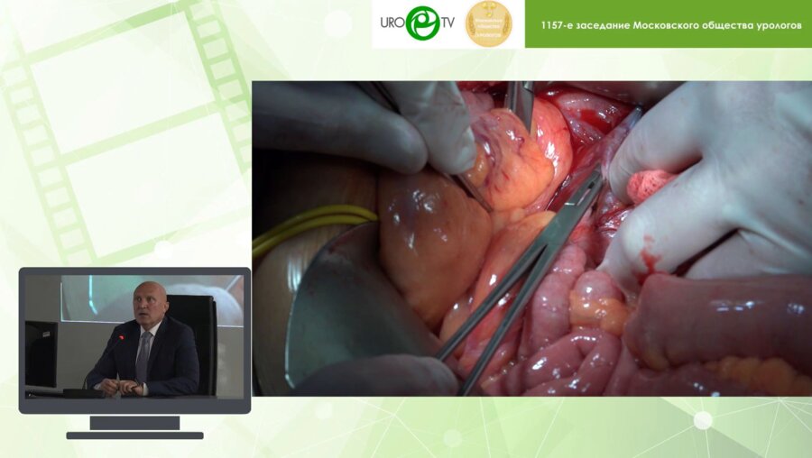 Даренков С.П. - Врожденная тазовая экстрофия. Уретеросигмостомия. Конверсия уретеросигмостомии в гетеротопический мочевой резервуар с формированием аппендикостомы