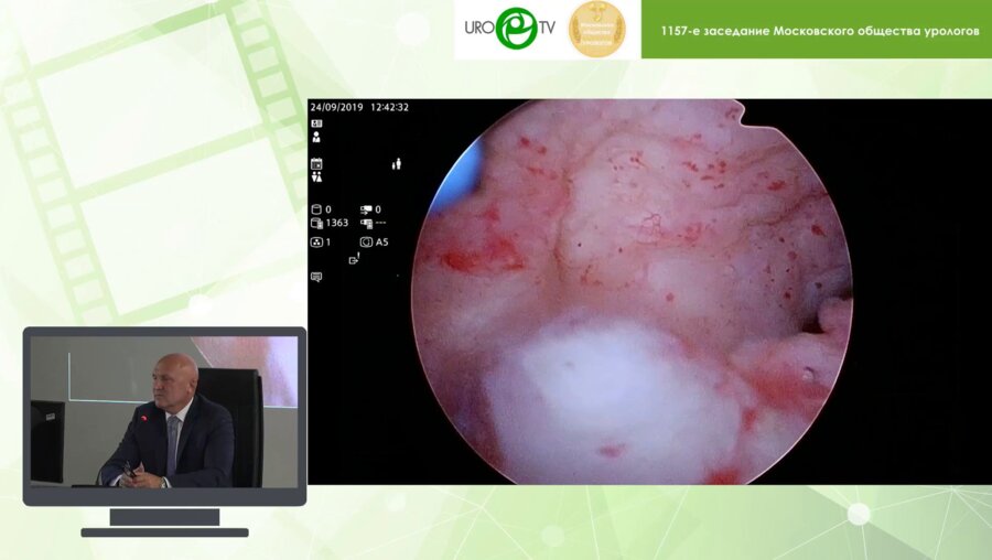 Кочкин А.Д. - Лапароскопическая коррекция редкого осложнения ТУР простаты